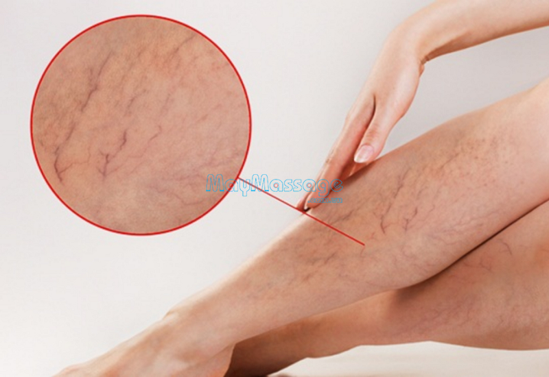Giãn tĩnh mạch chân sẽ nổi gân tím trên da và khó vận động