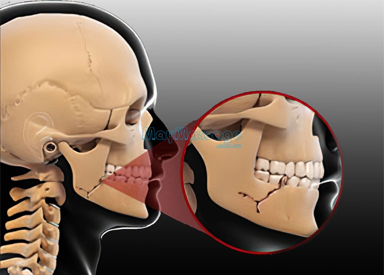 Cấu trúc của xương hàm lớn cũng làm cho khuôn mặt trở nên đầy đặn