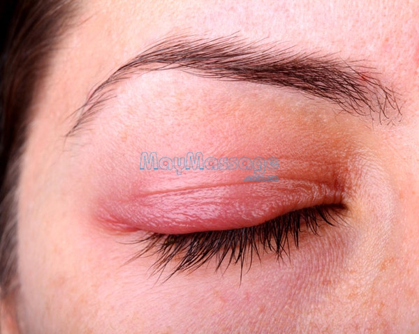 Mí mắt bị sưng nhưng không đau là triệu chứng rất khó đoán và có nhiều nguyên nhân gây ra