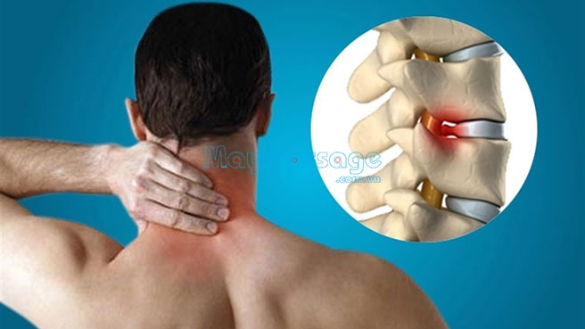 Thoát vị đĩa đệm gây ra tình trạng đau cổ bên trái