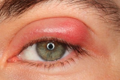 Nguyên nhân và triệu chứng mí mắt trên bị sưng nhưng không đau